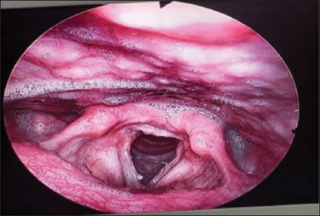 Bilateral vocal cord nodule.